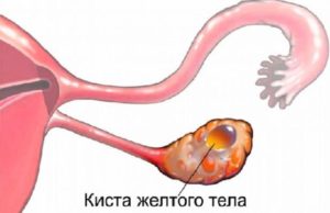 2 желтых тела в разных яичниках