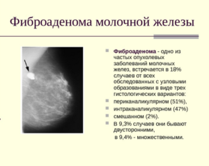 Филлоидная фиброаденома молочной железы