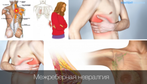 Межреберная невралгия отдает в молочную железу