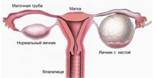 Неотложная помощь при разрыве кисты яичника