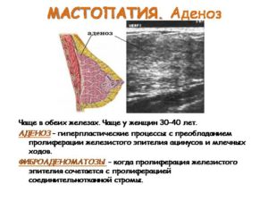 Преобладание железистой ткани в молочной железе что это такое