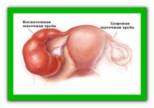 Лечение воспаления яичников в домашних условиях
