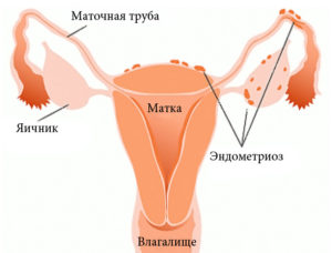 При эндометриозе какие выделения