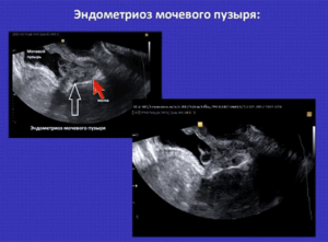 Эндометриоз мочевого пузыря симптомы лечение