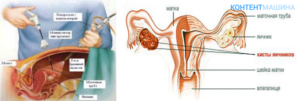 Анализы для лапароскопии кисты яичника