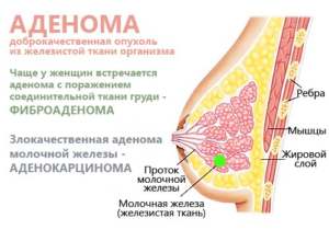 Фиброзно кистозная аденома молочной железы