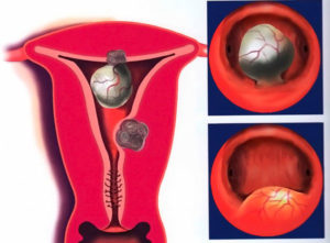 Миома матки от чего она появляется