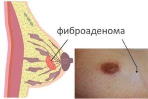 Чем лечить фиброаденому молочной железы