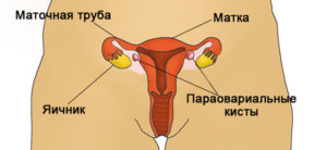 Параовариальная киста яичника слева