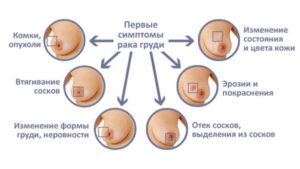 Первые признаки рака молочной железы на ранней стадии у женщин