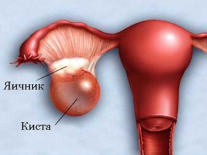 Киста яичника у мальчика подростка