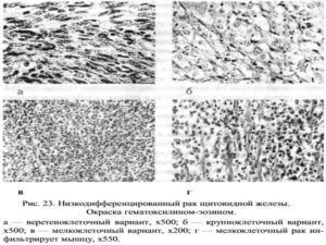 Низкодифференцированный рак молочной железы
