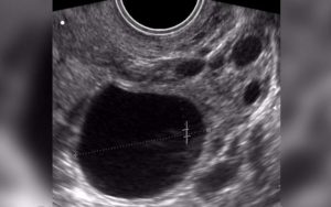 Доминантный фолликул в правом яичнике