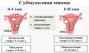 Субмукозная миома матки лечение