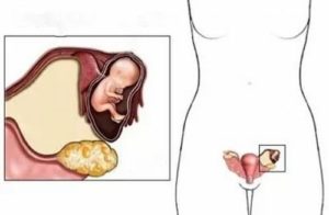 Левый яичник при беременности болит