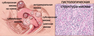 Гистология миомы матки