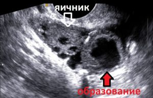 Беременность в яичнике