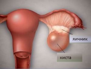 Может ли быть задержка месячных из за кисты яичника