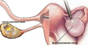 В яичнике жидкостное образование что это