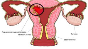 Внутренний эндометриоз матки