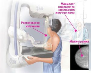Маммография и узи молочных желез в чем разница