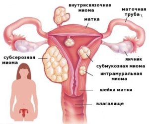 Миома и фибромиома в чем разница