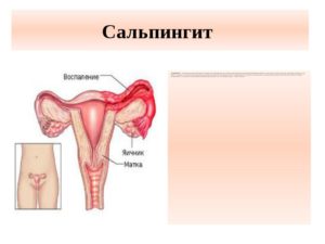 Туберкулез яичников у женщин