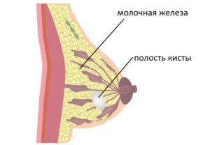 Солитарная киста молочной железы