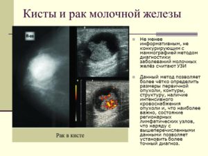 Как отличить фиброаденому молочной железы от рака