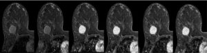 Мрт молочных желез с контрастом что показывает