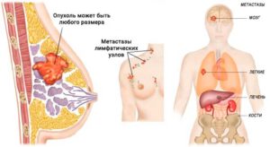 Метастазы в костях при раке молочной железы сколько живут