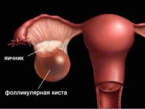 Серозная киста яичника лечение народными средствами