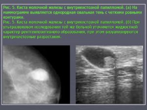 Как отличить кисту молочной железы от рака