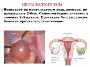 Регрессирующее желтое тело в яичнике