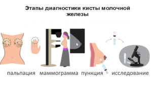 Киста молочной железы или фиброаденома
