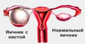 Можно ли пить алкоголь при кисте яичника