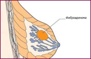 Аденома молочной железы что это