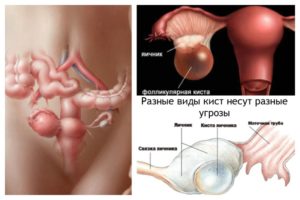 Киста яичника мешает ли забеременеть