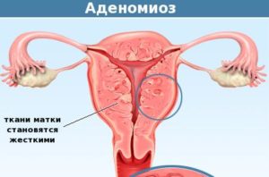 Миома матки в сочетании с эндометриозом что это