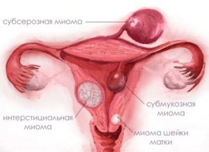 Беременность и интерстициальная миома матки