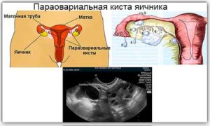 Параовариальная киста яичника справа
