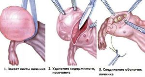 Лечение оперативное кисты яичника