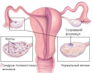 Беременность при поликистозе яичников