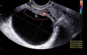 Киста яичника на узи