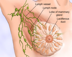 Удаление лимфоузлов под мышкой при раке молочной железы