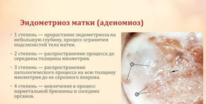 Эндометриоз внутренний диффузная форма