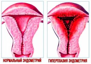 Гиперплазия эндометрия и миома матки это приговор