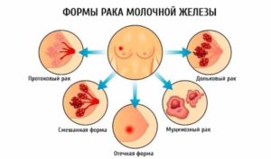 Лечение рака молочной железы 3 стадии с метастазами