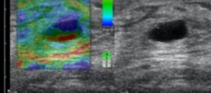 Соноэластография молочных желез