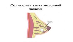 Солитарная киста молочной железы